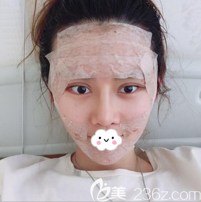 钟正强自体脂肪面部填充术后即刻