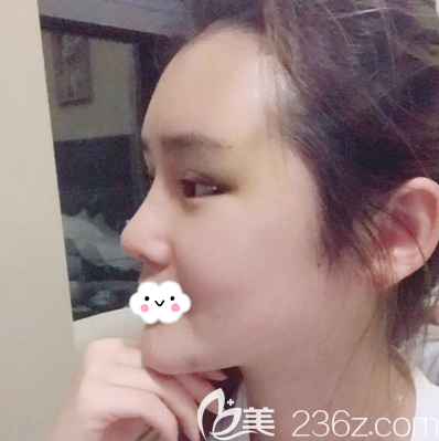 全面部脂肪填充术后3天