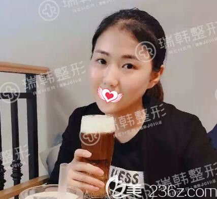 海南瑞韩明星祛眼袋术后一周效果