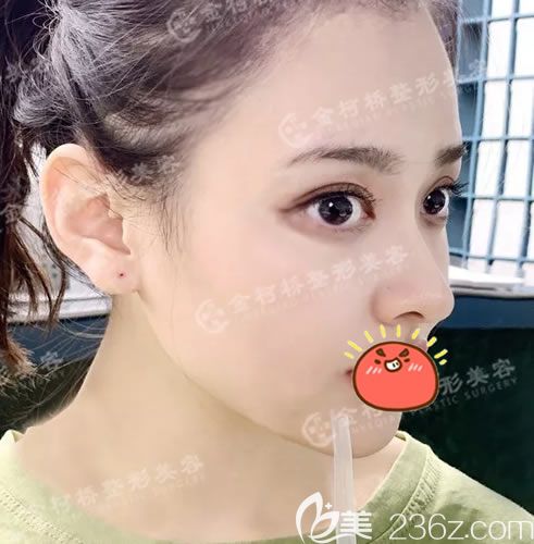 <!--<i data=20240703-sp></i>-->整形医院冯利光双眼皮案例