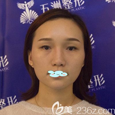 <!--<i data=20240703-sp></i>-->医疗整形美容医院黄媛媛面部玻尿酸面部填充+瘦脸除皱瘦脸术前照 <!--<i data=20240703-sp></i>-->医疗整形美容医院黄媛媛面部玻尿酸面部填充+瘦脸除皱瘦脸术前照