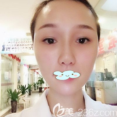 <!--<i data=20240703-sp></i>-->黄媛媛面部玻尿酸面部填充+瘦脸除皱瘦脸术后3天效果图 <!--<i data=20240703-sp></i>-->黄媛媛面部玻尿酸面部填充+瘦脸除皱瘦脸术后3天效果图