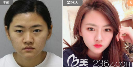 杨辉医生假体隆鼻案例