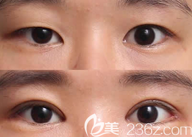 杨辉医生切开双眼皮案例
