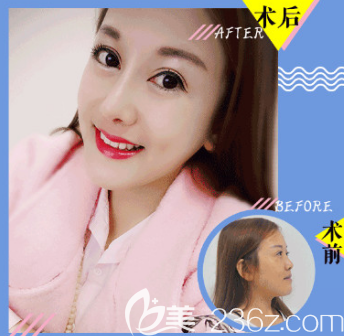 杜学莹医师隆鼻案例