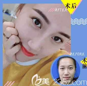 杜学莹医生全切双眼皮案例