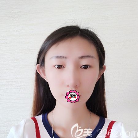 黑龙江瑞丽切开双眼皮术前照 黑龙江瑞丽切开双眼皮术前照