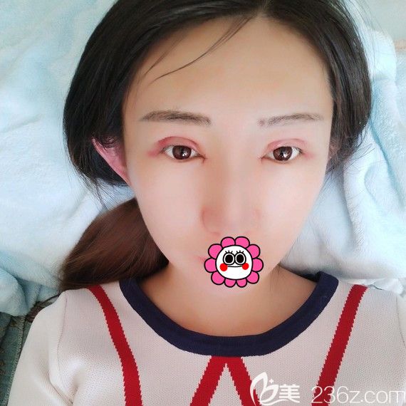 黑龙江瑞丽双眼皮术后3天眼睛红肿 黑龙江瑞丽双眼皮术后3天眼睛红肿