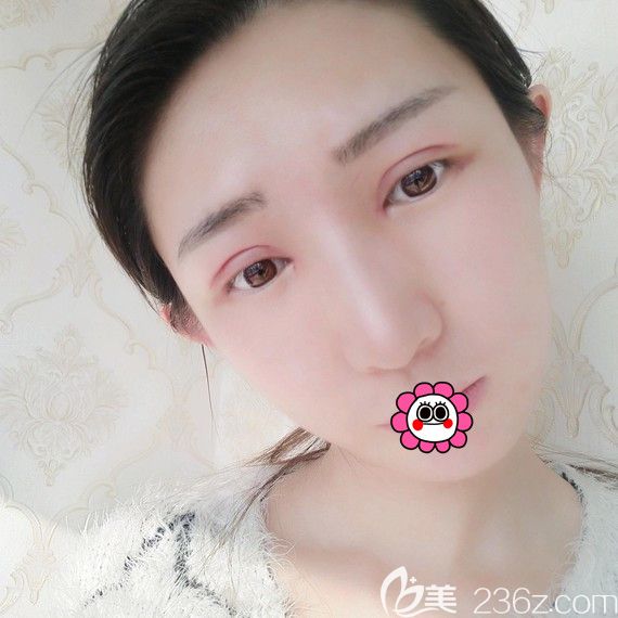 黑龙江瑞丽双眼皮术后7天拆完线后 黑龙江瑞丽双眼皮术后7天拆完线后