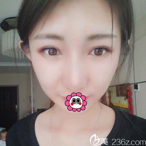 黑龙江瑞丽双眼皮术后一个月效果 黑龙江瑞丽双眼皮术后一个月效果