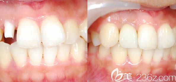 广州圣贝口腔詹春华主任前牙种植效果图 广州圣贝口腔詹春华主任前牙种植效果图