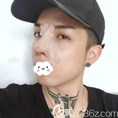 颜子云肋软骨隆鼻术后即刻 颜子云肋软骨隆鼻术后即刻