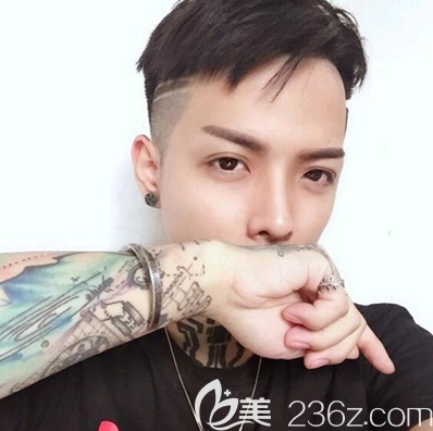 自体肋软骨隆鼻术后一个月恢复效果 自体肋软骨隆鼻术后一个月恢复效果