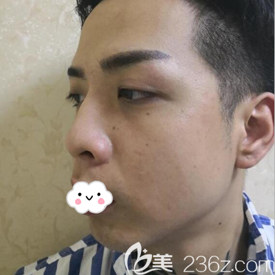 说术前鼻子侧面有些驼峰鼻 说术前鼻子侧面有些驼峰鼻