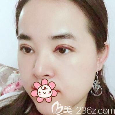 全切双眼皮术后4天恢复图 全切双眼皮术后4天恢复图