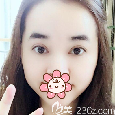 切开双眼皮术后半个月恢复效果 切开双眼皮术后半个月恢复效果