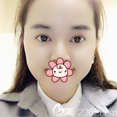 车红昌切开双眼皮开眼角术后2个月恢复照 车红昌切开双眼皮开眼角术后2个月恢复照