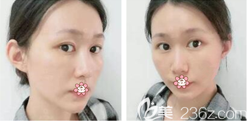 王志军面部线雕术后一周