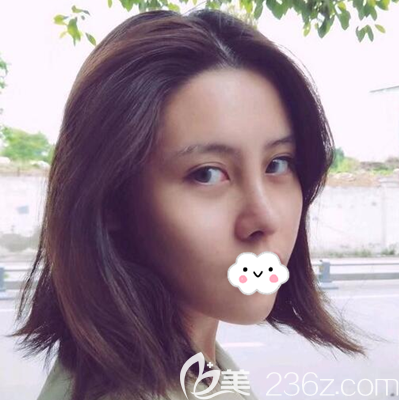 假体+耳软骨复合隆鼻术后半个月 假体+耳软骨复合隆鼻术后半个月