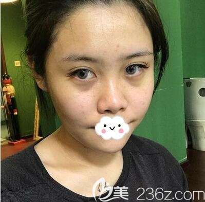 做耳软骨隆鼻的术前照片 做耳软骨隆鼻的术前照片