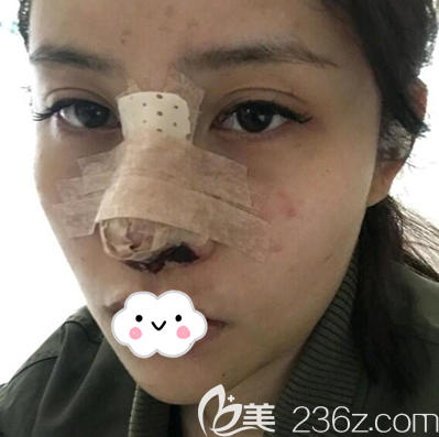 成都西区医院邓东伟隆鼻术后即刻 成都西区医院邓东伟隆鼻术后即刻