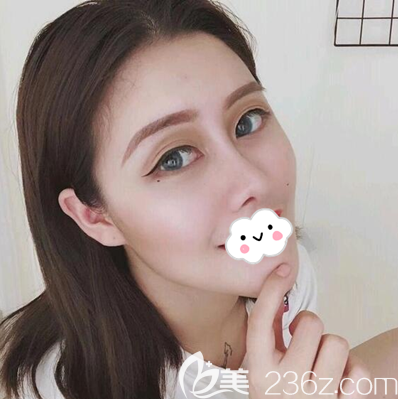 假体隆鼻+耳软骨垫鼻尖综合隆鼻3个月 假体隆鼻+耳软骨垫鼻尖综合隆鼻3个月