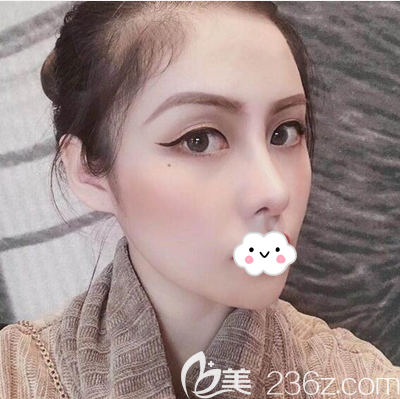 邓东伟鼻综合术后200天效果 邓东伟鼻综合术后200天效果