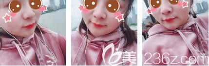 上海玫瑰医疗美容医院张东旭鼻综合+瘦脸除皱术后二十五天