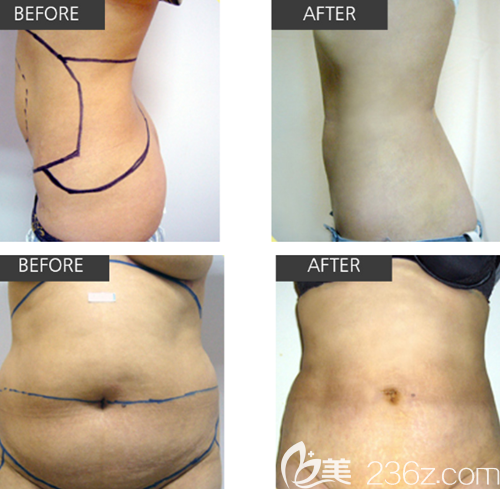 韩国CDU清潭优吸脂手术案例 韩国CDU清潭优吸脂手术案例