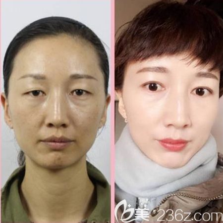 韩国清潭优注射美肤案例 韩国清潭优注射美肤案例