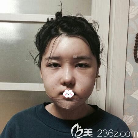 韩国DA整形医院李相雨磨骨瘦脸+面部填充术后效果