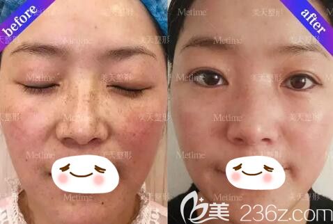 双皮秒祛斑真人前后效果对比