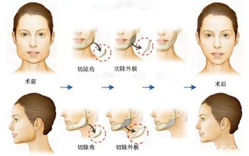 手术过程示意图 手术过程示意图