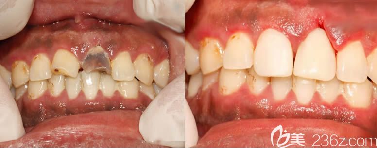 厦门登特口腔前牙种植修复案例效果图