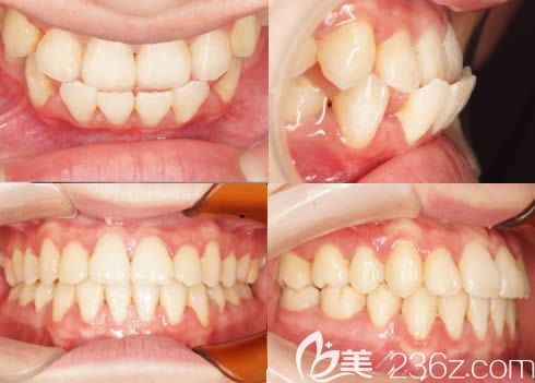 厦门登特口腔牙齿美学正畸前后图