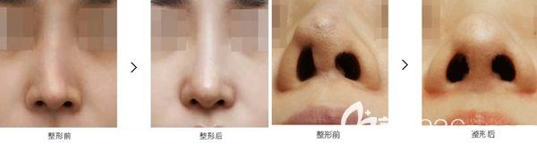 韩国原辰鼻修复手术案例