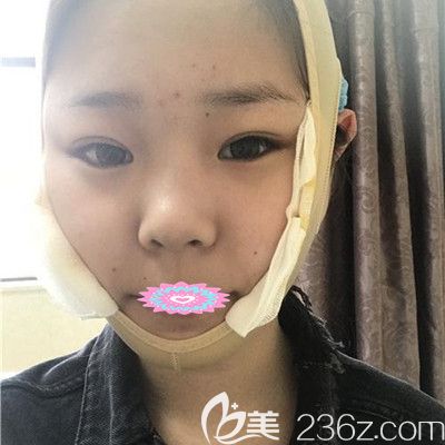 武汉华美付国友下颌骨整形术后2天图片展示