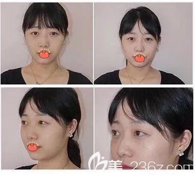 义乌阳光医院做双眼皮手术前 义乌阳光医院做双眼皮手术前