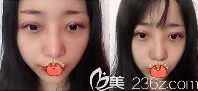 义乌阳光做双眼皮<span style= 义乌阳光做双眼皮<span style=