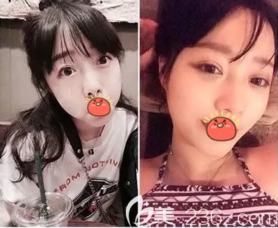 义乌阳光医院双眼皮<span style= 义乌阳光医院双眼皮<span style=