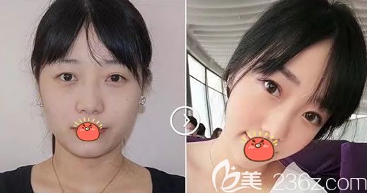 义乌阳光双眼皮<span style= 义乌阳光双眼皮<span style=