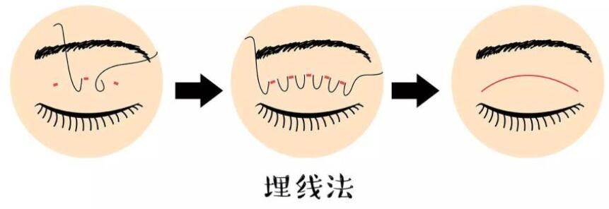 上海伯思立医疗美容门诊部魏国茜讲解埋线双眼皮的做法 上海伯思立医疗美容门诊部魏国茜讲解埋线双眼皮的做法