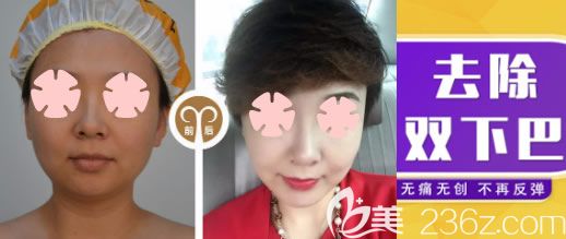 北海美秀中禾整形下巴吸脂前后对比图 北海美秀中禾整形下巴吸脂前后对比图