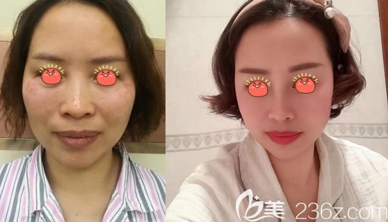 金华瑞丽假体隆鼻案例对比图 金华瑞丽假体隆鼻案例对比图