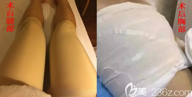 我在北海美秀中禾做吸脂隆胸术后 我在北海美秀中禾做吸脂隆胸术后