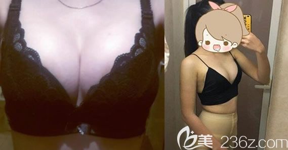 我在美秀中禾做自体脂肪隆胸术后一周照片 我在美秀中禾做自体脂肪隆胸术后一周照片