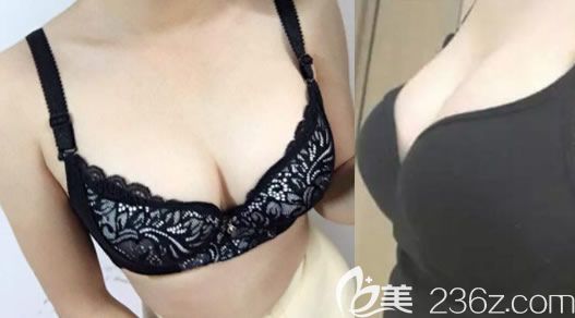 北海整形医院哪家好？用我在美秀中禾整形做大腿吸脂和自体脂肪隆胸真实案例来说话