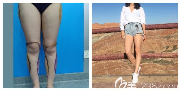 武汉华美刘光伟腿部吸脂塑形术后效果对比展示照