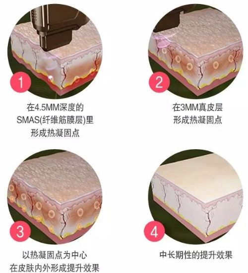 SHURINK LIFTING提升原理