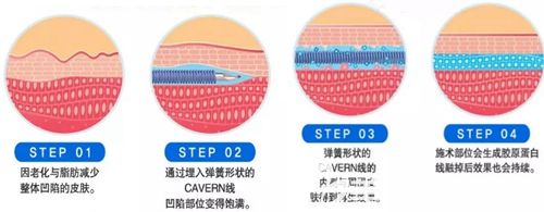 韩国CAVERN提升原理